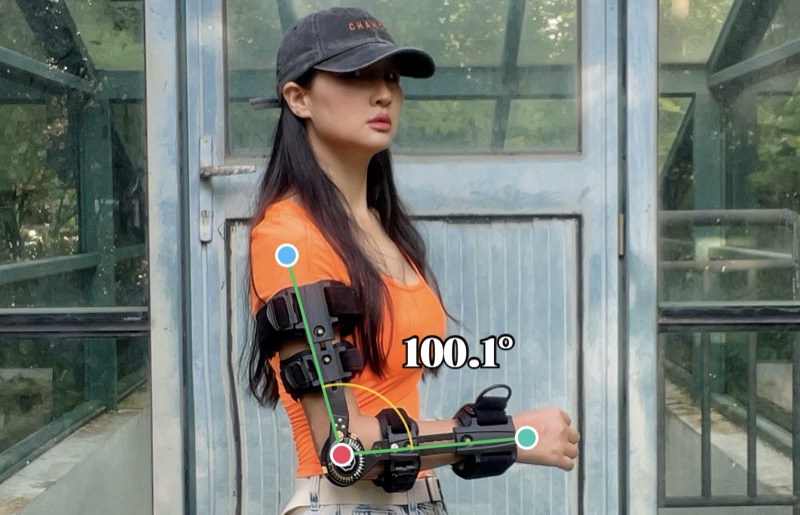 Elbow flexion limited to about 100 degrees with orthopedic brace after fracture